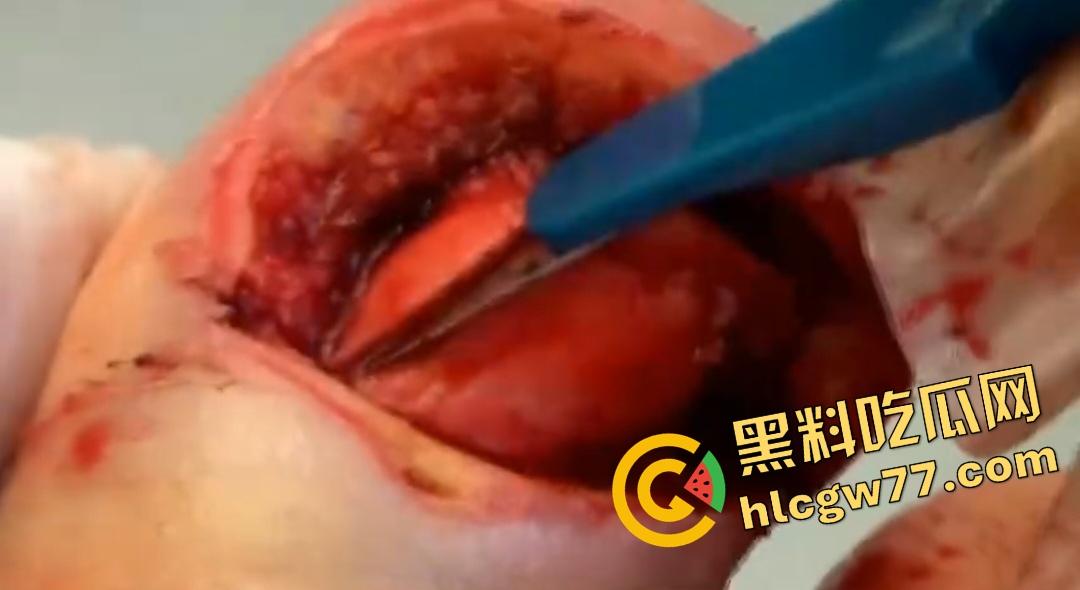 患者天天啃脚指甲狂得甲沟炎！帕尔米耶里手术刀下血肉狂飙，操刀医生差点呕吐！  第7张