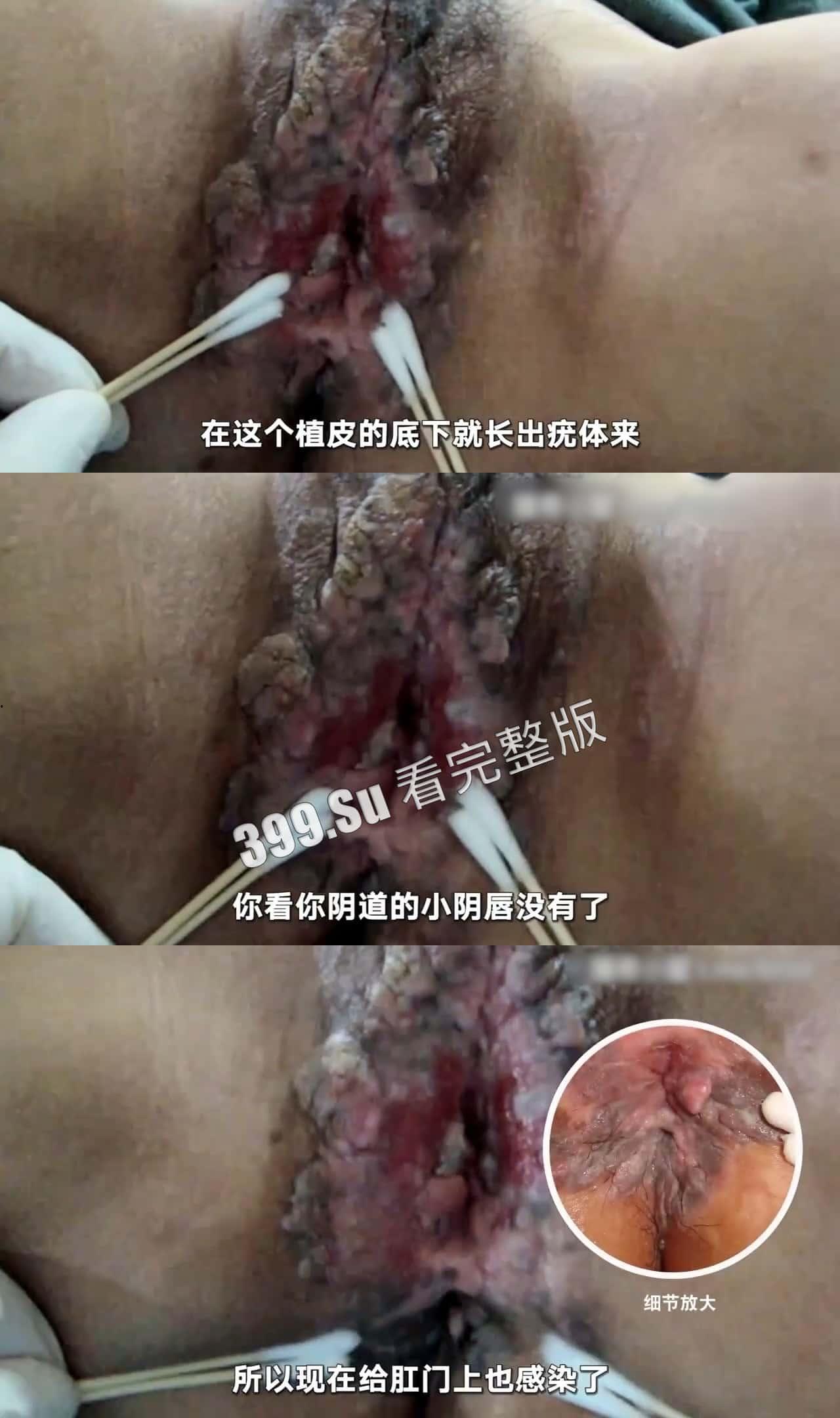 性病篇  谨慎观看！瓜友们出门在外 一定得洁身自爱 世界上没有后悔药 安全第一！！！ 第1张