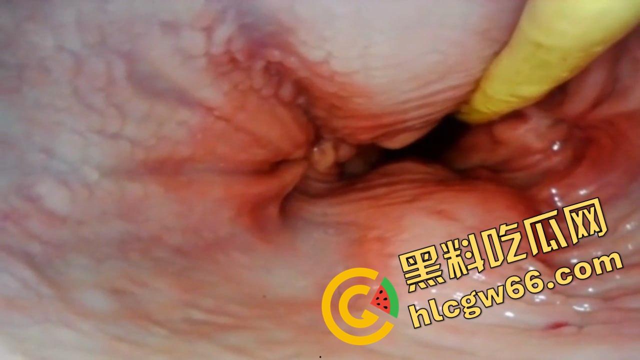 欧美巨屌狂插内窥视角爆火阴道深处褶皱翻卷、肉壁收缩蠕动,全程高清记录快感源头! 第11张 欧美巨屌狂插内窥视角爆火阴道深处褶皱翻卷、肉壁收缩蠕动,全程高清记录快感源头! 第11张