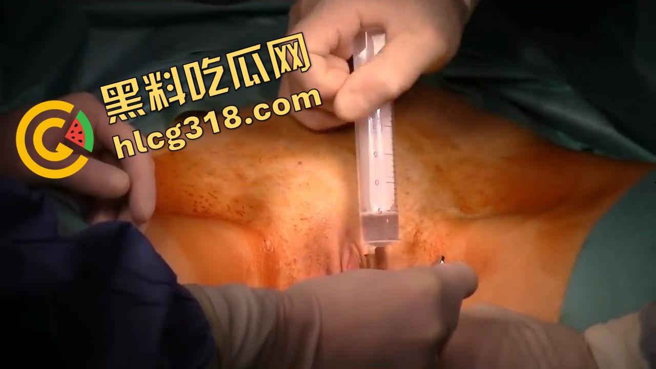 阴唇整形一刀逆天改命，黑木耳变粉鲍鱼，大阴唇手术直接打造一线天馒头逼，姑娘做完直接彩礼翻倍！  第8张