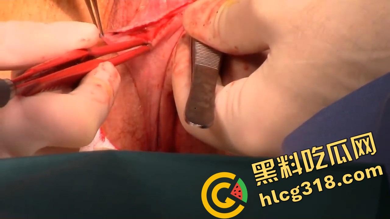 阴唇整形一刀逆天改命，黑木耳变粉鲍鱼，大阴唇手术直接打造一线天馒头逼，姑娘做完直接彩礼翻倍！  第11张