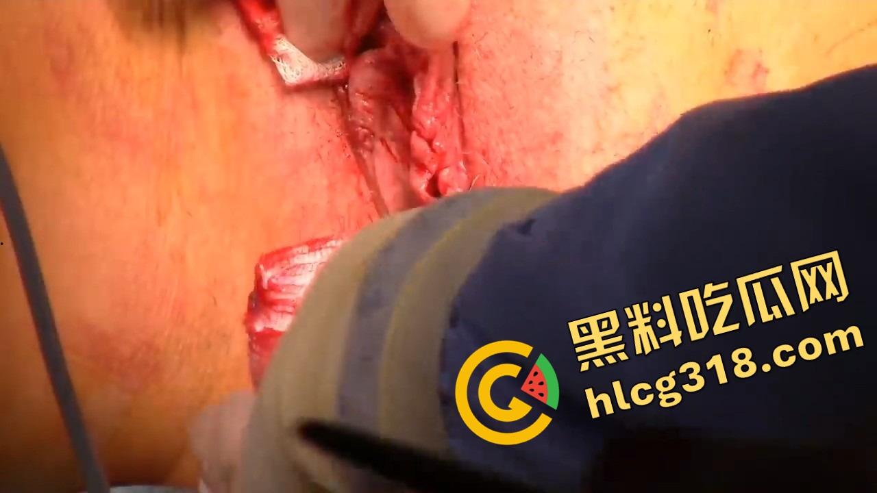 阴唇整形一刀逆天改命，黑木耳变粉鲍鱼，大阴唇手术直接打造一线天馒头逼，姑娘做完直接彩礼翻倍！  第13张