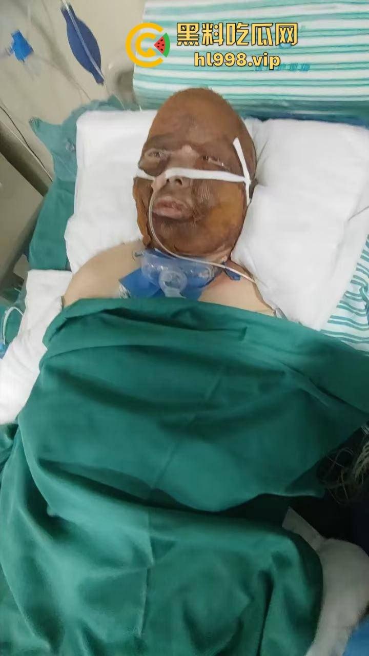 伟大的母亲！浙江诸暨市家中厨房煤气爆炸妻子惨遭烧伤之痛  第5张