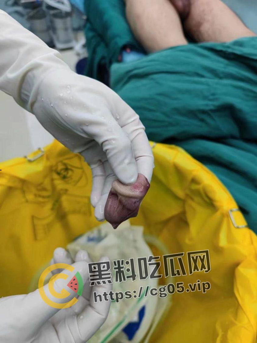 神医在世！ 鸡鸡被女友咬断都能接回去 还不影响性功能  第1张