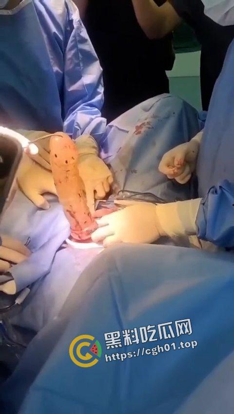 活久见！超大假阳具塞进体内拿不出来只能做手术 你们男同玩的都这么狠吗  第3张