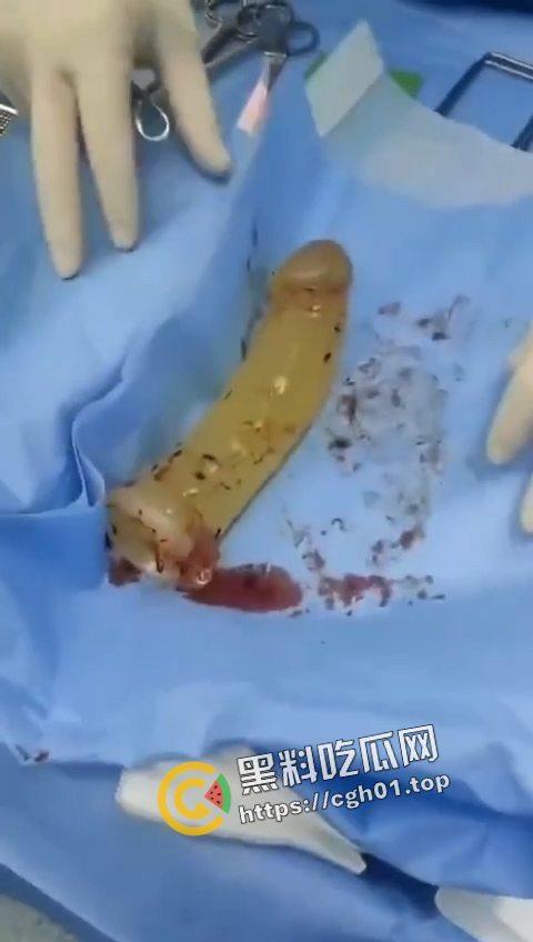 活久见！超大假阳具塞进体内拿不出来只能做手术 你们男同玩的都这么狠吗  第4张