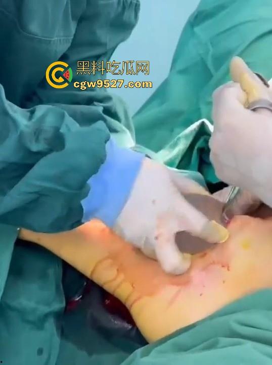 隆胸整形手术现场大曝光！平乳妹秒变巨乳御姐，手术过程一览无遗，女人为变美的代价真大！  第5张