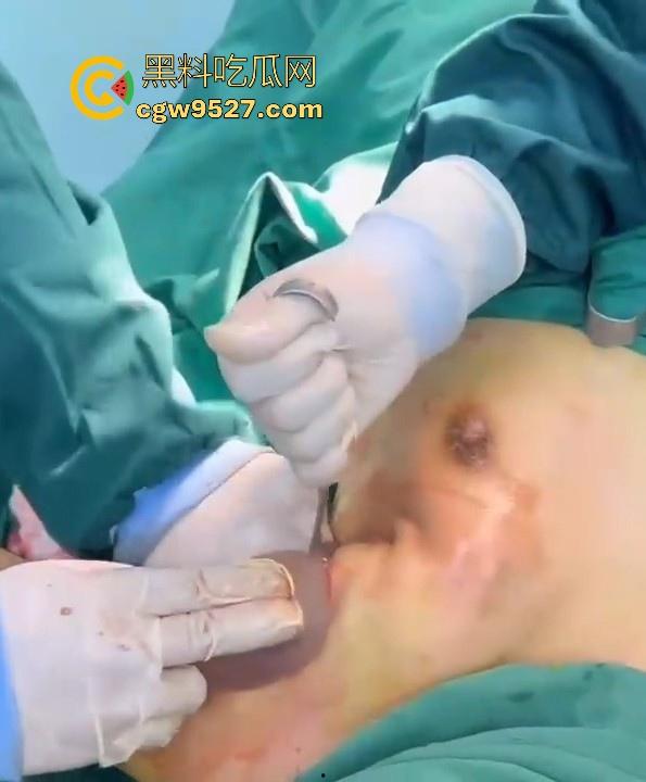 隆胸整形手术现场大曝光！平乳妹秒变巨乳御姐，手术过程一览无遗，女人为变美的代价真大！  第6张