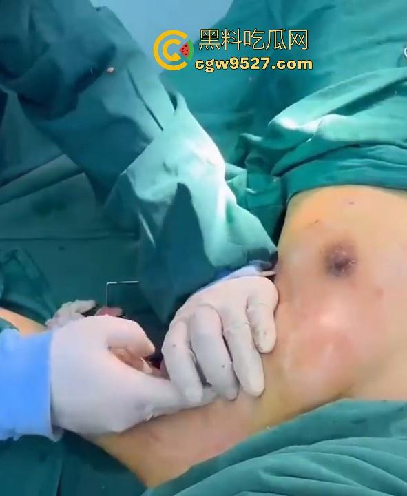 隆胸整形手术现场大曝光！平乳妹秒变巨乳御姐，手术过程一览无遗，女人为变美的代价真大！  第7张