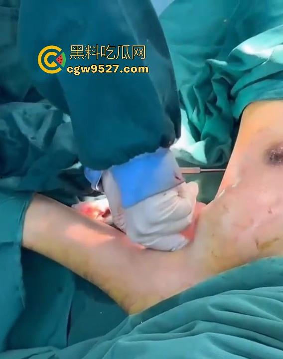 隆胸整形手术现场大曝光！平乳妹秒变巨乳御姐，手术过程一览无遗，女人为变美的代价真大！  第8张