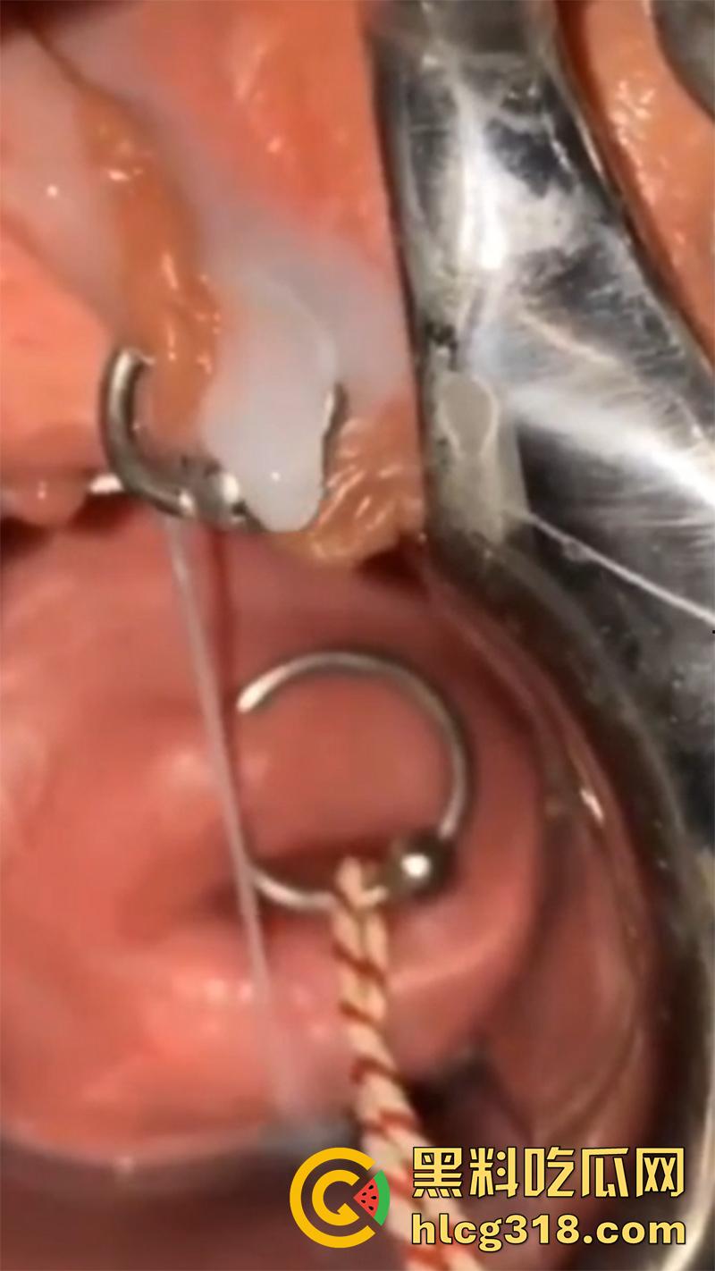 重口极限引导扩张虐穴，逼里塞图钉钢管插子宫口，鸡巴爆插尿道操的骚逼白浆四溢，宫颈真像个鱼唇！  第7张