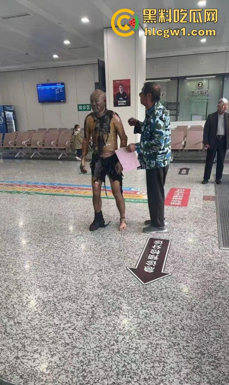 江苏常州易化工厂油罐爆炸 现场员工大面积烧伤 场面骇人 现场视频曝光皮都烧掉了  第5张